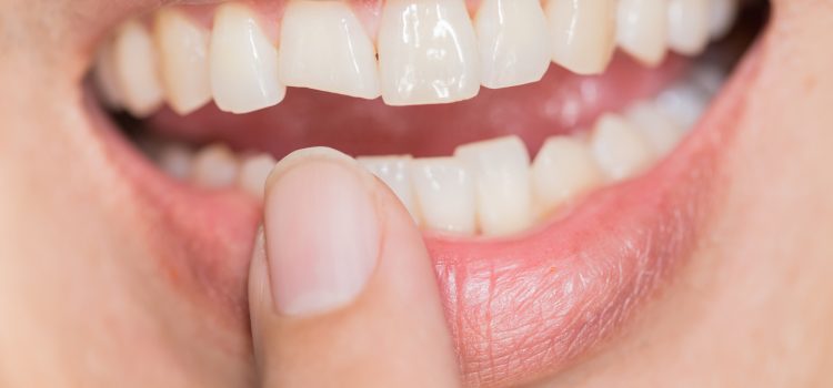 Jakie są metody odbudowy ukruszonych zębów?